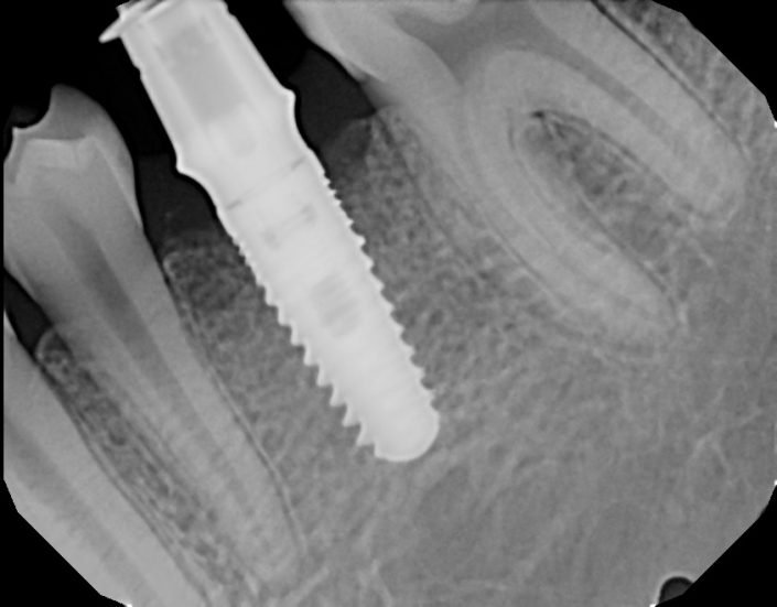 Bountiful dental implant